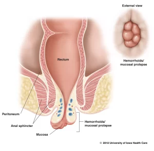 Hemorrhoidal prolapse showing internal hemorrhoids, rectum, anal sphincter, and mucosal prolapse.