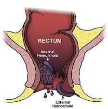 Internal and external hemorrhoids illustrated in an anatomical model of the rectum and anal canal.